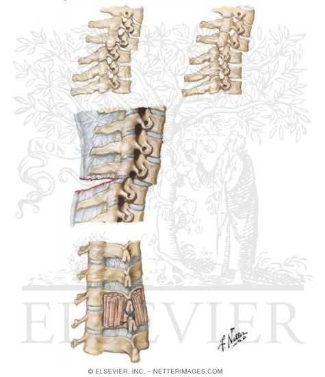 Subluxation and Ligamentous Instability of Cervical Spine
Trauma