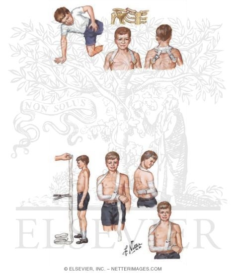 Watermarked preview of unlabeled image: Fracture of Clavicle in Children, Fracture of Proximal Humerus in Children