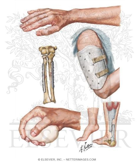 Joint Stiffness After Fracture
