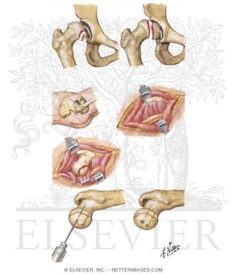 Watermarked preview of unlabeled image: Dislocation of Hip with Fracture of Femoral Head