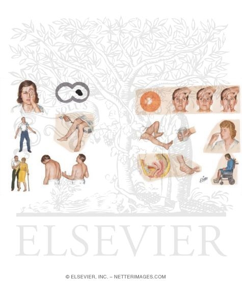 Watermarked preview of unlabeled image: Multiple Sclerosis: Clinical Manifestations