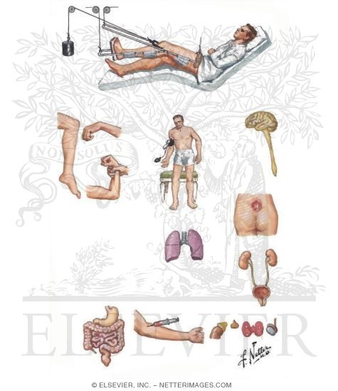 Watermarked preview of unlabeled image: Immobilization