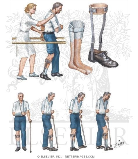 Ambulation After Stroke