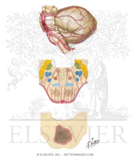 Occlusion of Basilar Artery and Branches