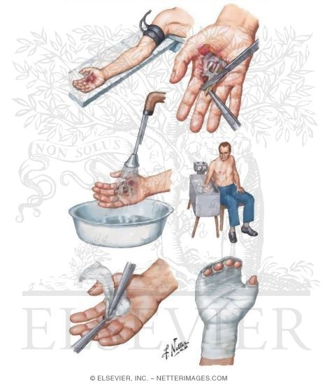 Infected Wounds of Hand and Fingers