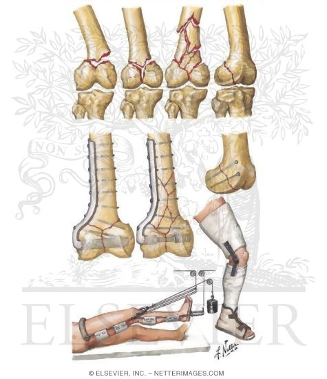 Fracture of Distal Femur
