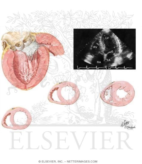 Left Ventricular Hypertrophy