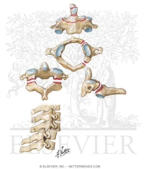 Fracture and Dislocation of Cervical Vertebrae Trauma