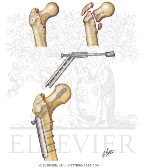 Intertrochanteric Fracture of Femur