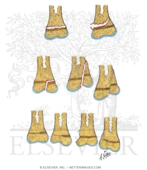 Watermarked preview of unlabeled image: Injury to Growth Plate (Salter-Harris Classification, Rang Modification)