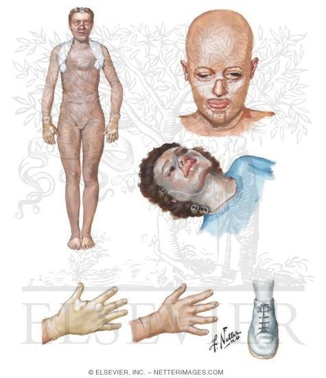 Watermarked preview of unlabeled image: Pressure Garments and Devices in Burn Rehabilitation