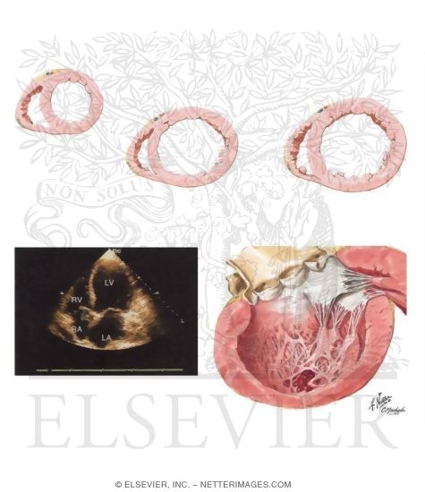 Cardiac Remodeling Secondary to Volume Overload