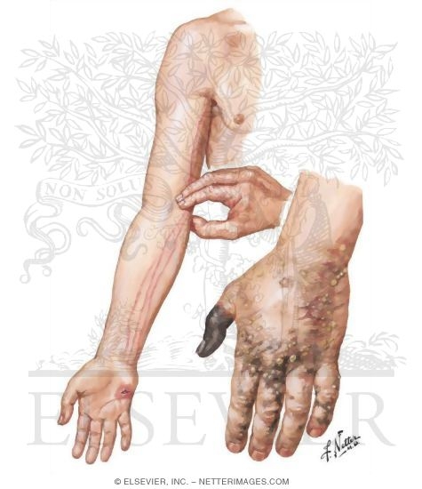 Lymphangitis