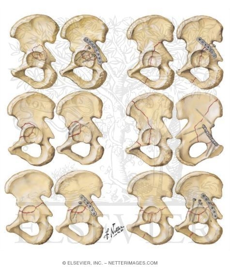 Watermarked preview of unlabeled image: Fracture of Acetabulum
