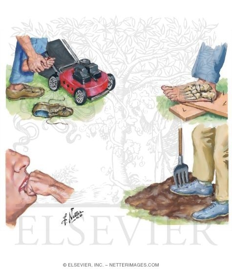 Watermarked preview of unlabeled image: Open Injury with High Risk for Infection