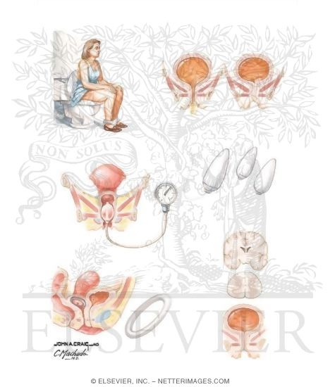 Watermarked preview of unlabeled image: Conservative Management
Pessary Therapy