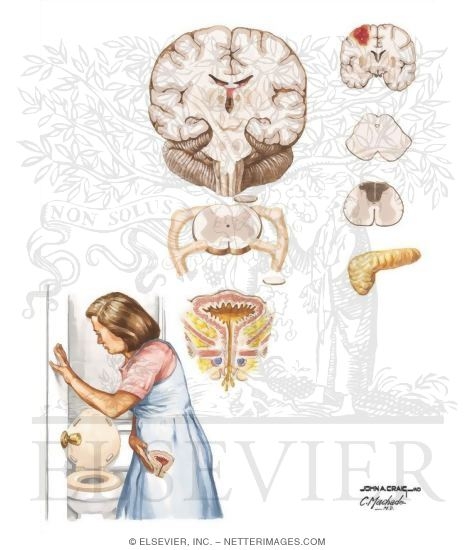 Watermarked preview of unlabeled image: Detrusor Instability and Hyperreflexia
Anthroscopic Treatments
Urinary Incontinence: Bypass, Overflow, Stress, and Urge