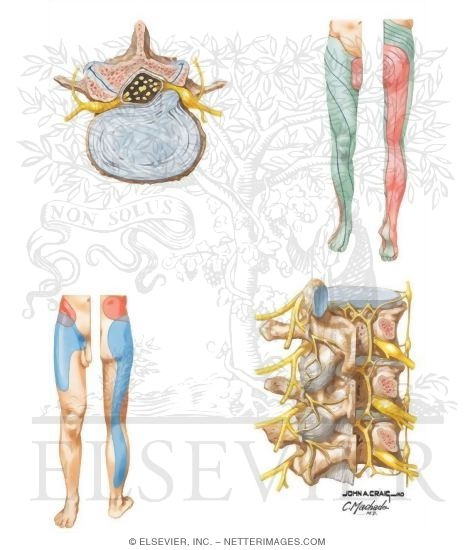 Pain Patterns in Lumbar Disease