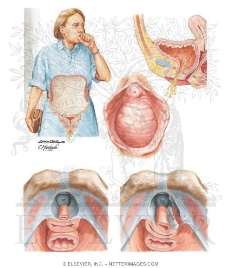 Urinary Incontinence: Bypass, Overflow, Stress, and Urge