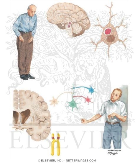 Subcortical Dementias