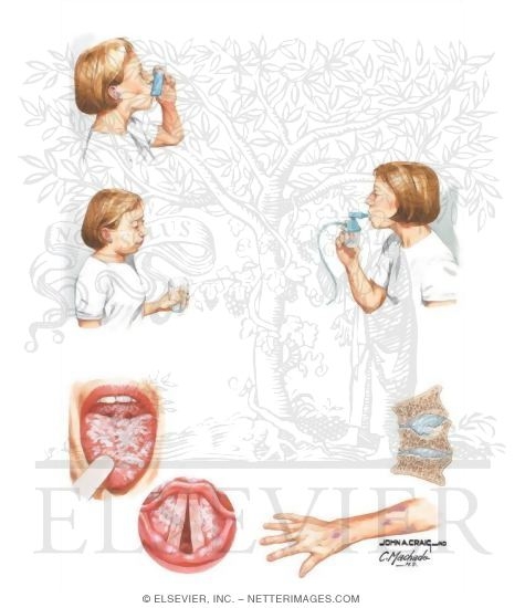 Watermarked preview of unlabeled image: Pharmacologic Management In Asthma, Side Effects of Corticosteroids