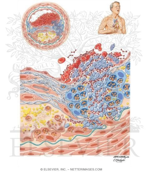 Watermarked preview of unlabeled image: Atherogenesis: Unstable Plaque Formation