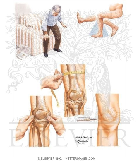 Watermarked preview of unlabeled image: Clinical Findings In Osteoarthritis (OA)
