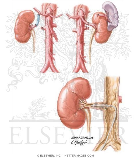 Watermarked preview of unlabeled image: Revascularization and Angioplasty
