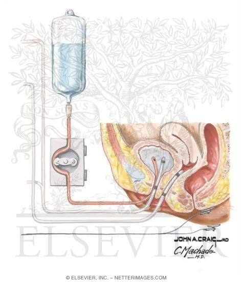 Urodynamics Testing