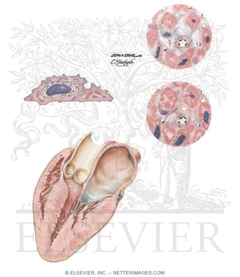 Myocardial Fibrosis