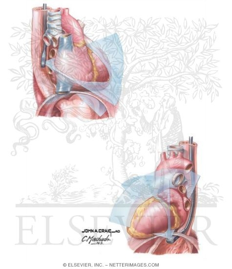 Transesophageal Echocardiography