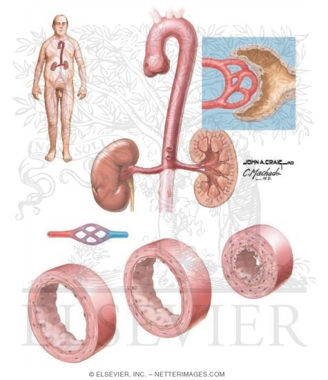 Watermarked preview of unlabeled image: Resistance Axis and Vascular Remodeling