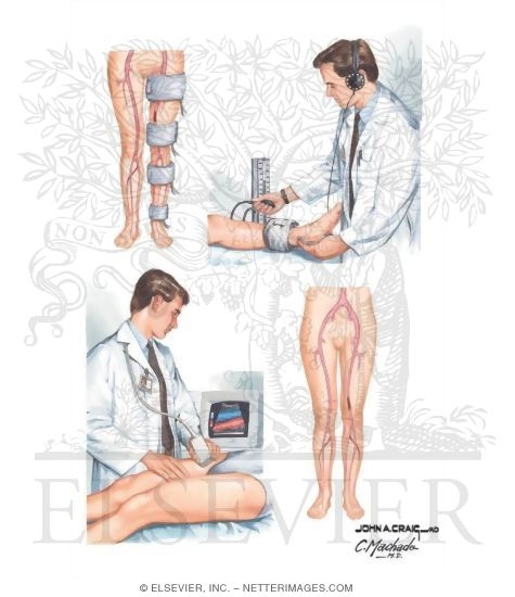 Watermarked preview of unlabeled image: Noninvasive Tests for Occlusive Peripheral Arterial Disease (PAD)