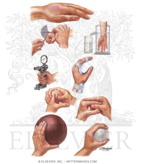 Watermarked preview of unlabeled image: Rehabilitation After Injury to Hand and Fingers