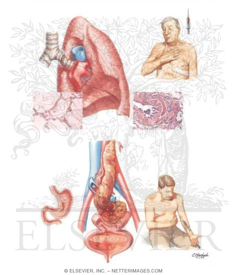 Watermarked preview of unlabeled image: Organ-Specific Complications
