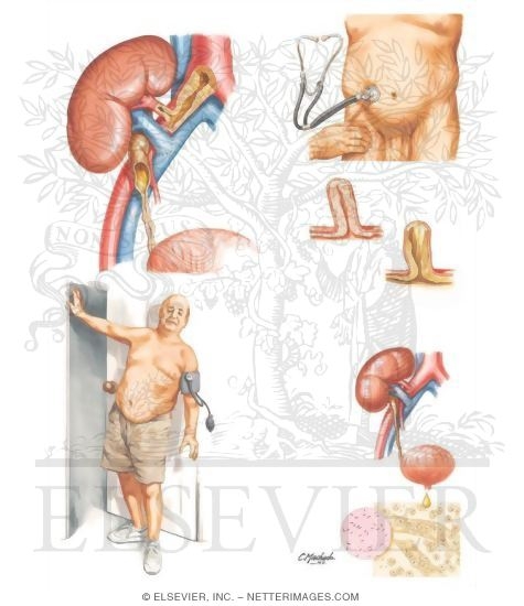 Watermarked preview of unlabeled image: Late Complications of Renal Transplantation