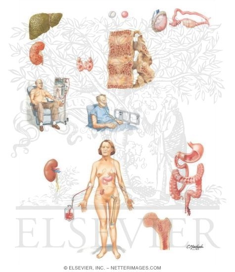 Watermarked preview of unlabeled image: Complications Common to All Transplantations