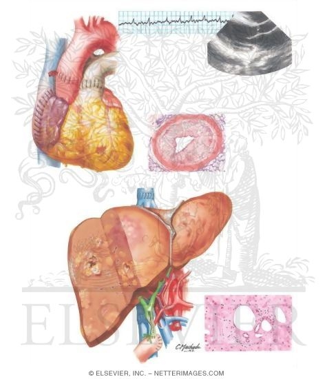 Watermarked preview of unlabeled image: Organ-Specific Complications