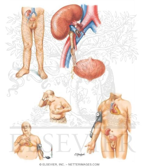 Watermarked preview of unlabeled image: Early Complications of Renal Transplantation