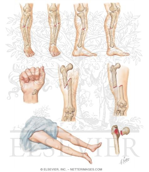 Watermarked preview of unlabeled image: Types of Displacement