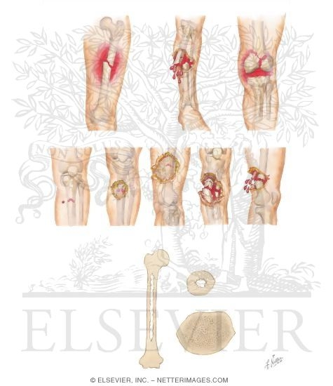 Watermarked preview of unlabeled image: Classification of Fracture; Open and Closed Fractures