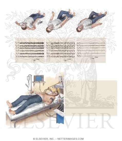 Watermarked preview of unlabeled image: Epilepsy: Generalized and Status Epilepticus