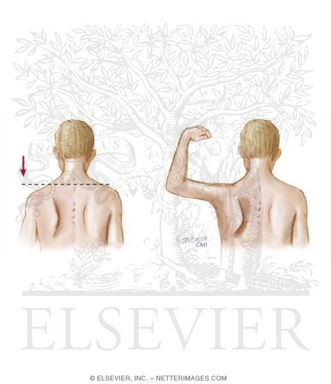 Clinical Findings In Cranial Nerve XI Damage