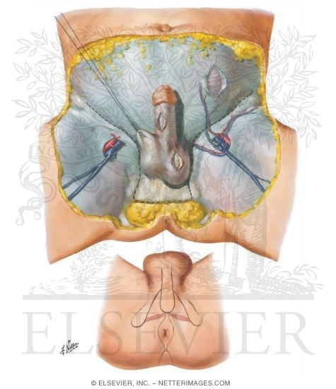 Watermarked preview of unlabeled image: Perineum and External Genitalia (Superficial Dissection)