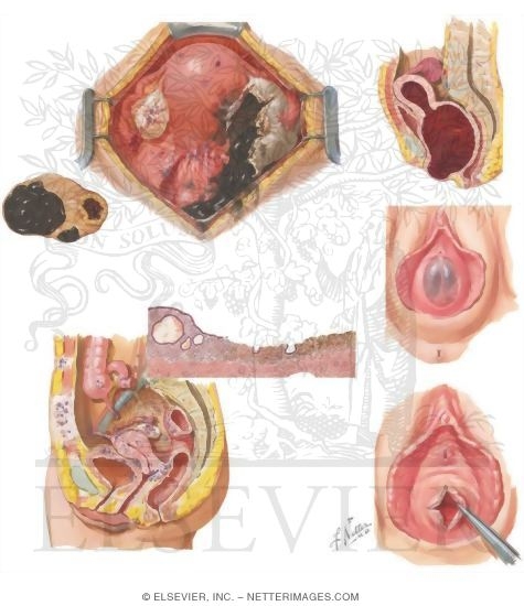 Watermarked preview of unlabeled image: Endometriosis