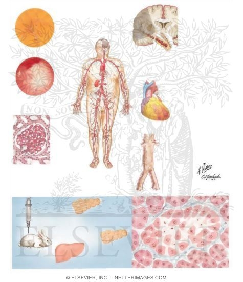 Microvascular and Macrovascular Complications In Diabetes