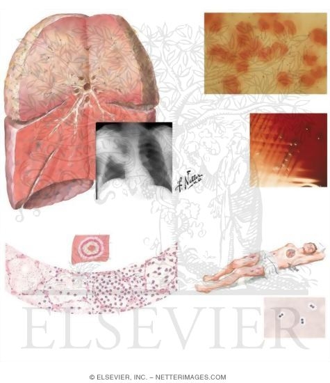 Watermarked preview of unlabeled image: Pneumococcal Pneumonia
