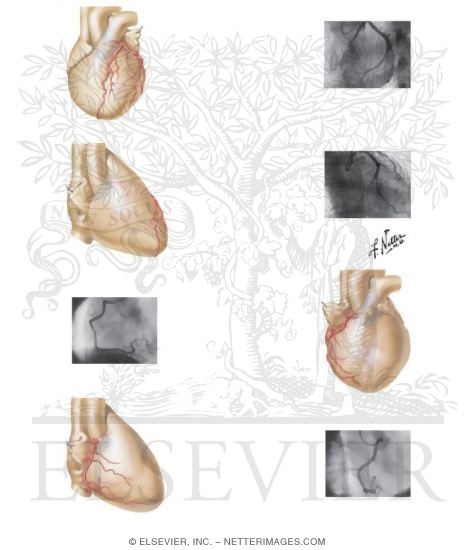 Coronary Angiog...