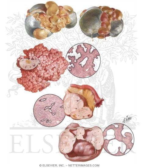 Illustration of Epithelial Stromal Ovarian Tumors from the Netter Collection