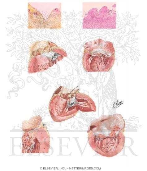 Watermarked preview of unlabeled image: Bacterial Endocarditis